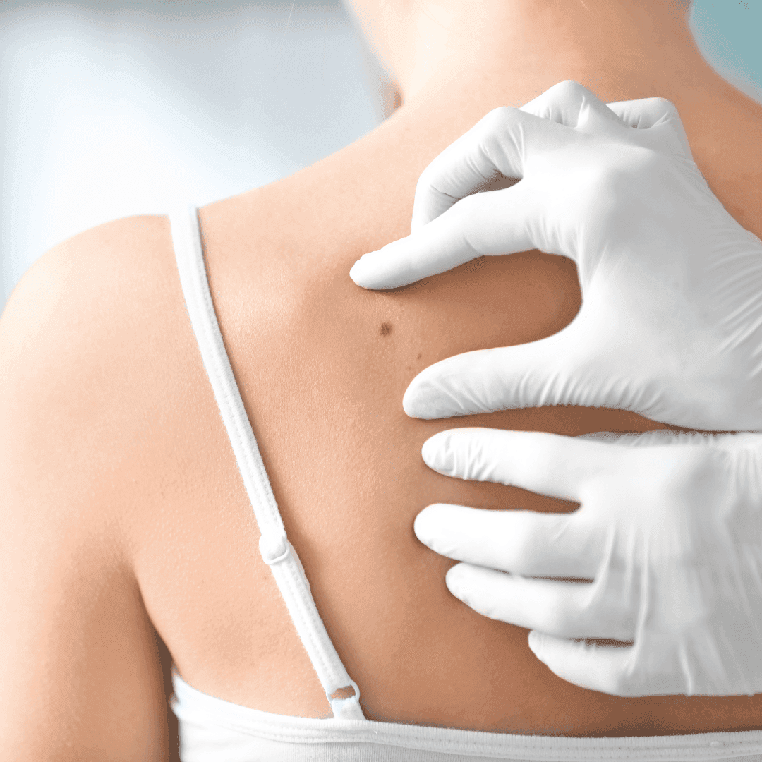 Sette incontri nei Distretti, rivolti alle Cure Primarie, con il Dermatologo Maurizio Lombardo, per conoscere meglio il melanoma e promuovere l'appropriatezza dei percorsi.  Stasera, alle 19.00, il primo incontro nella Casa di Comunità di Varese.