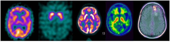 Nuove prospettive per la cura dei tumori cerebrali