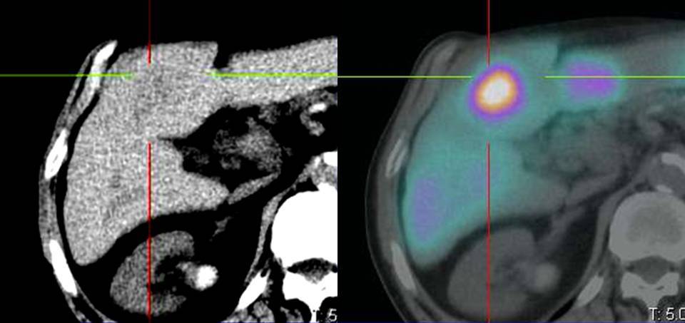 Microsfere radioattive per curare i tumori del fegato all'Ospedale di Circolo