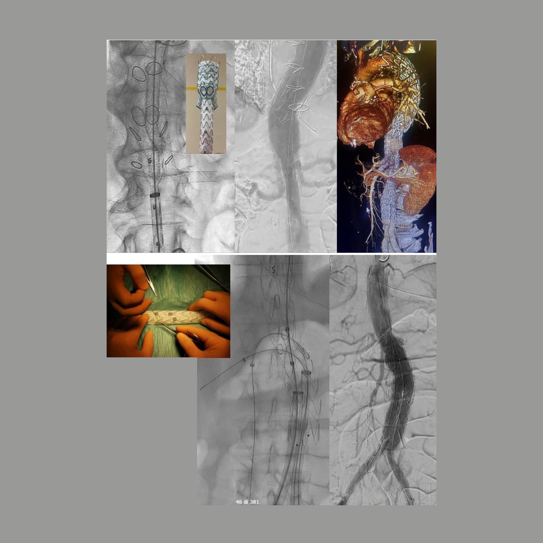La Chirurgia vascolare varesina in prima linea negli interventi con endoprotesi