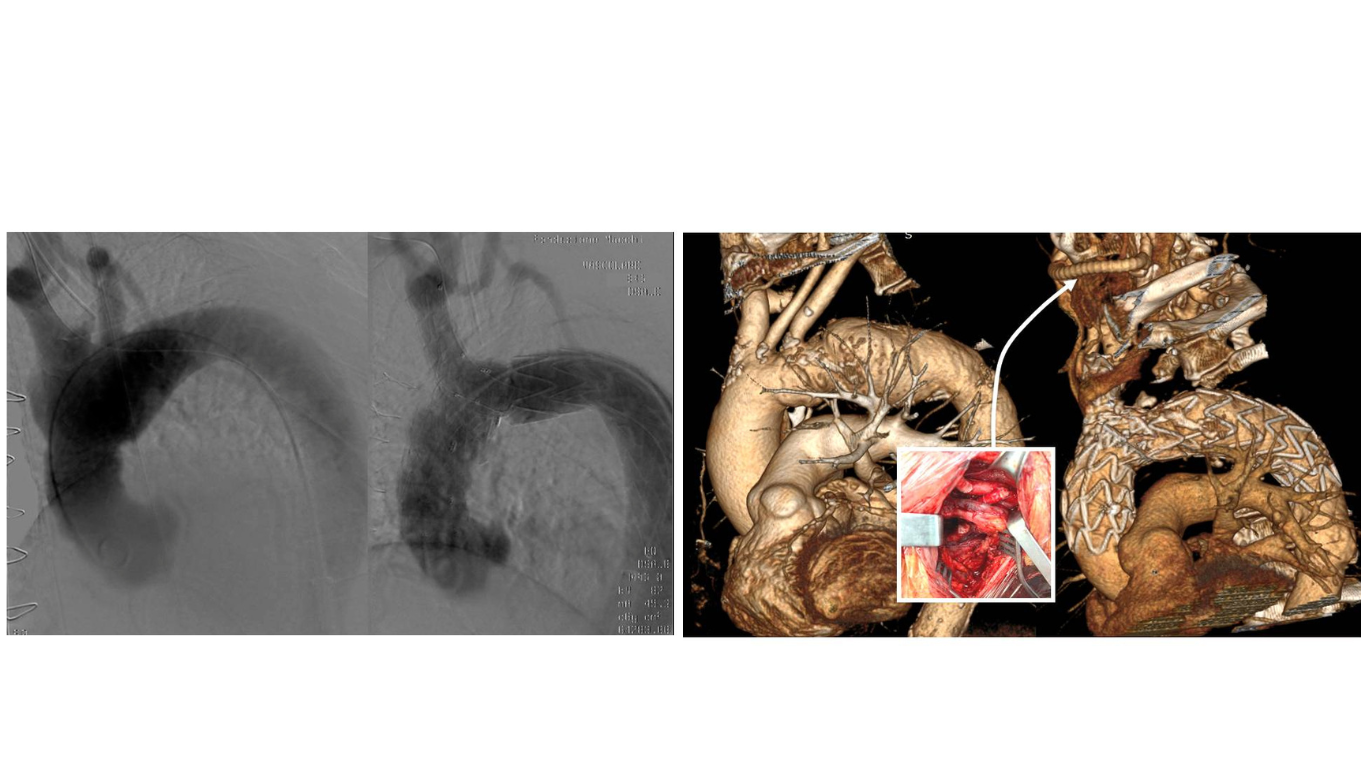 La Chirurgia vascolare varesina nel ristretto gruppo di chirurgie vascolari in Italia ad impiantare un'endoprotesi ramificata per il trattamento della patologia dell’aorta ascendente ed arco aortico.